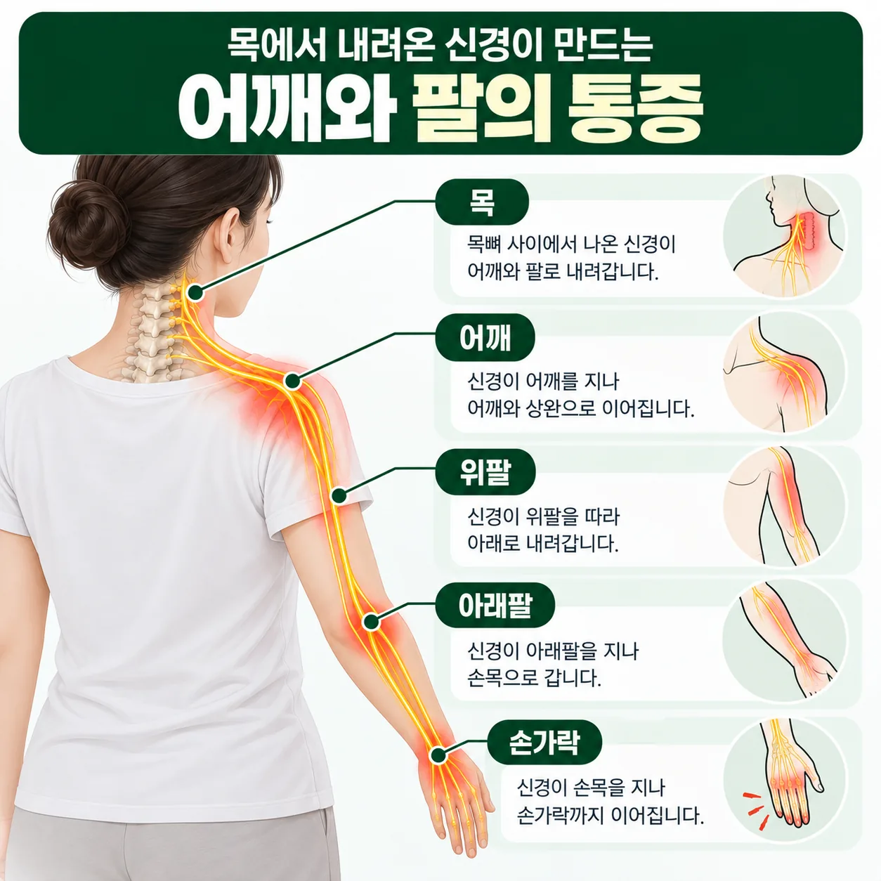 목에서 나온 신경이 어깨와 팔을 지나 손가락까지 내려가는 경로 개념도