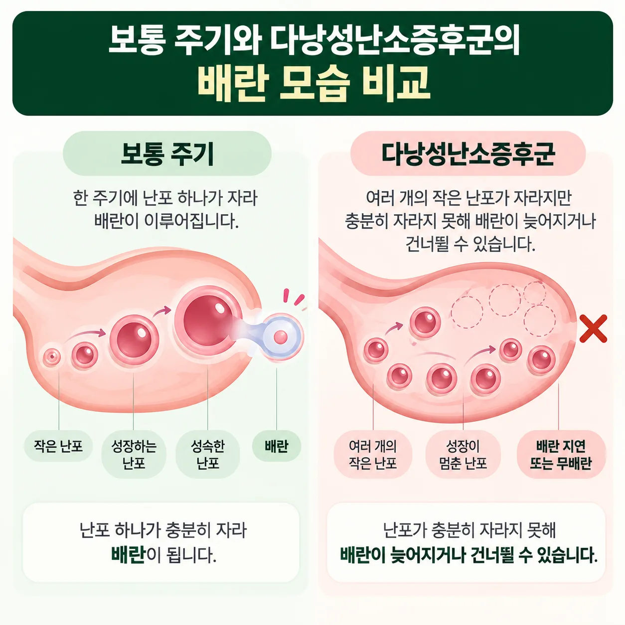 보통 주기의 배란과 다낭성난소증후군에서 배란이 늦어지는 모습을 비교한 개념도